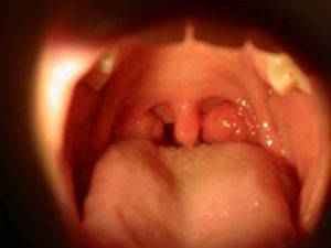 Удаление аденоидов у детей: как удаляют, стоит ли делать операцию, отзывы