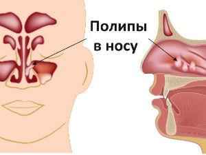 Лечение полипов в носу народными средствами: как вылечить чистотелом, отзывы