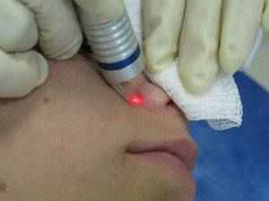 Лазерная коагуляция носовых paковин и сосудов носа