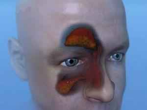 Народные средства от гайморита для носа, рецепты с медом и отзывы о лечении