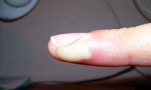 Сонник Гной, к чему снится Гной во сне видеть