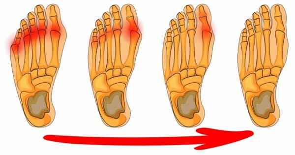 4 эффективных способа избавиться от шишек на ногах