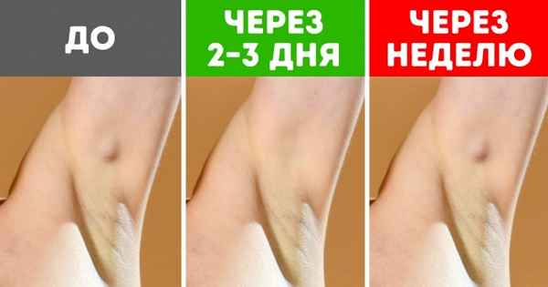 6 признаков болезней, которые можно обнаружить, если просто посмотреть на подмышки