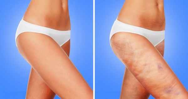 7 проблем с организмом, о которых могут сообщать беспричинные синяки на теле