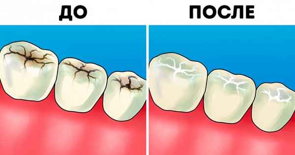 8 ответов на самые наболевшие вопросы об уходе за зубами от пpaктикующего врача-стоматолога