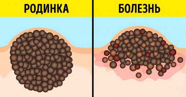 9 опасных мифов о родинках и загаре, в которые верят даже некоторые врачи