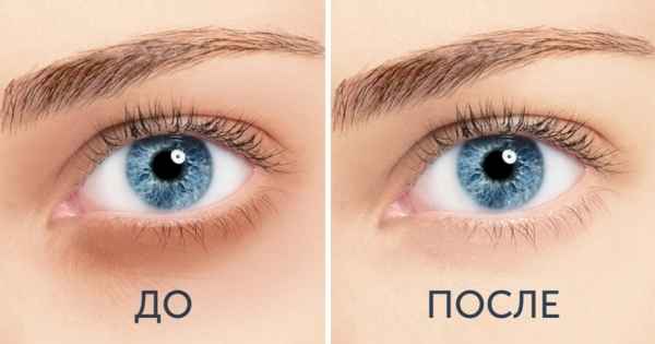 10 средств от темных кругов под глазами, которые можно приготовить дома