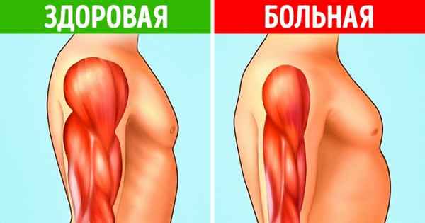 Дегенерация мышц начинается с 8 ранних симптомов