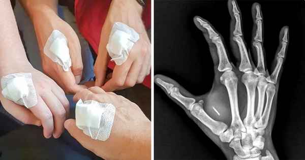 Жители Швеции массово усовершенствуют свои руки, и от такой новости становится слегка не по себе